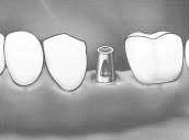 künstliche Zahnwurzel